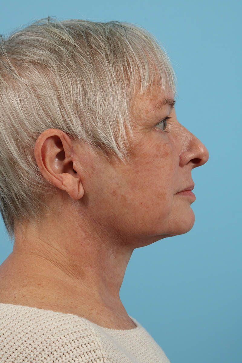 Neck Lift Before & After Image
