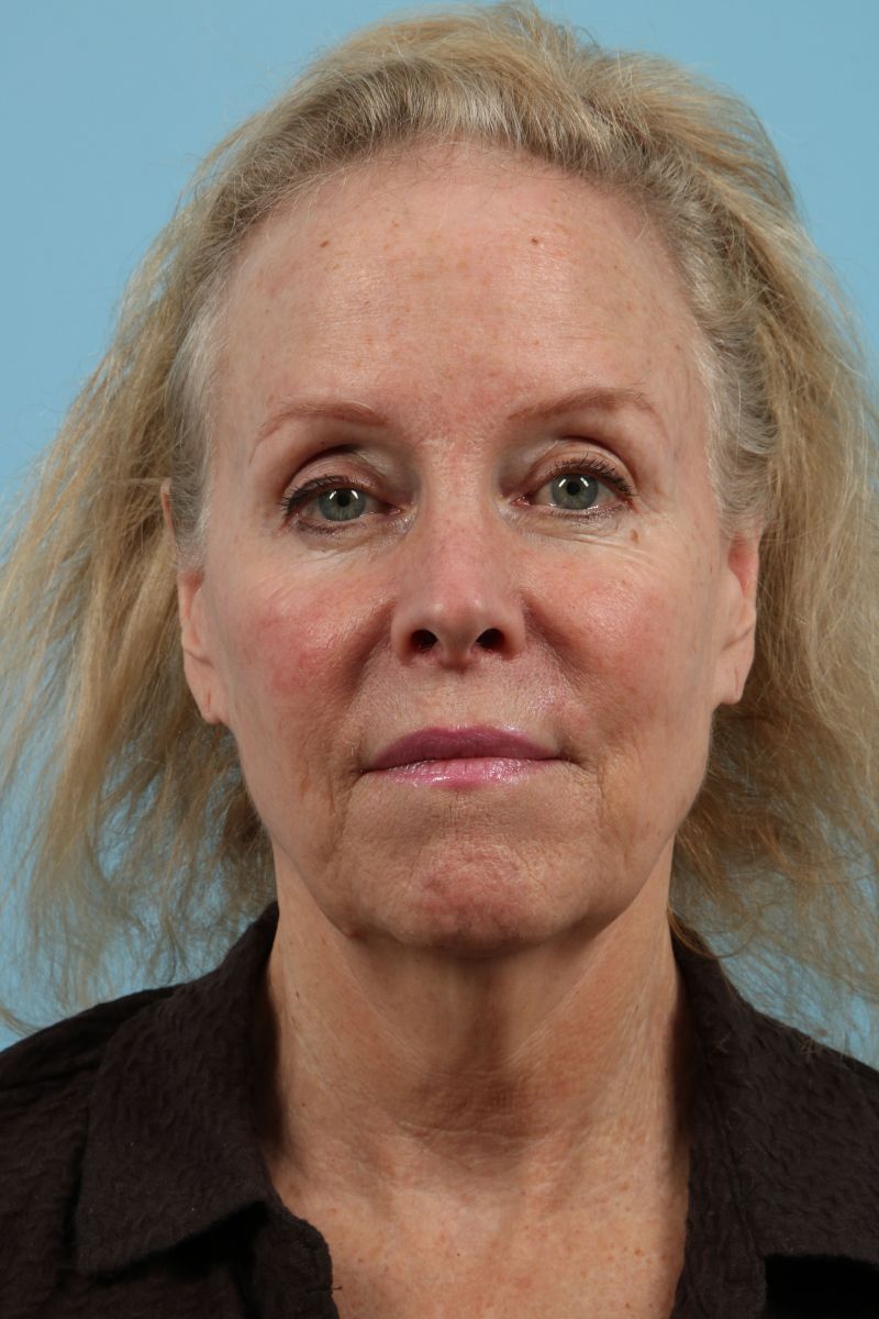 Neck Lift Before & After Image