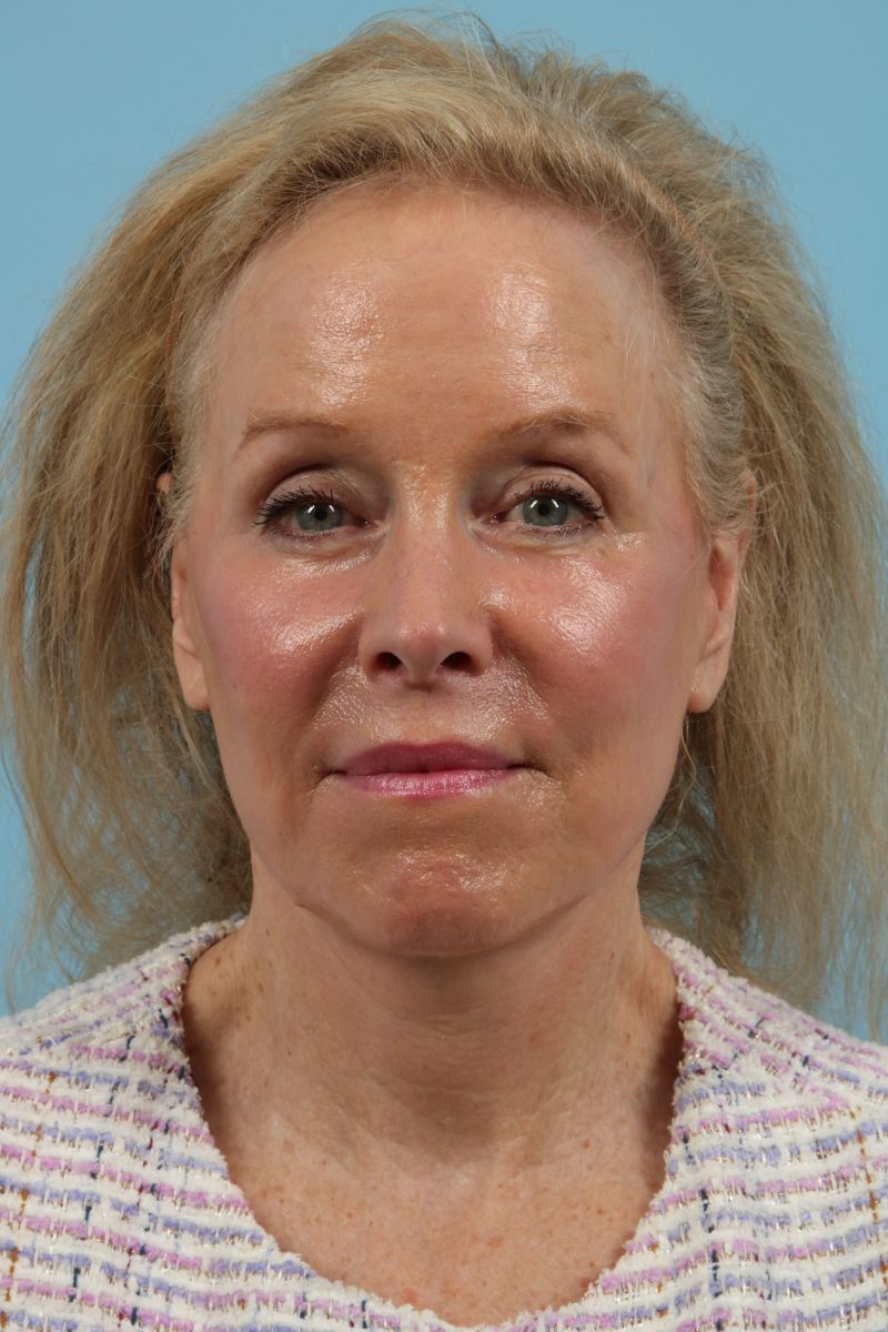 Neck Lift Before & After Image