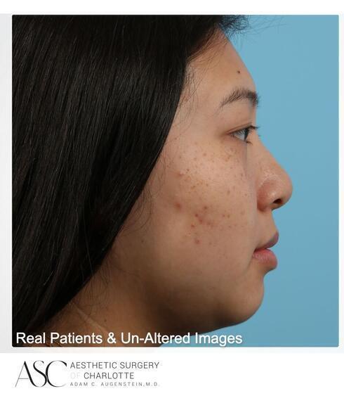 Submental Liposuction Before & After Image