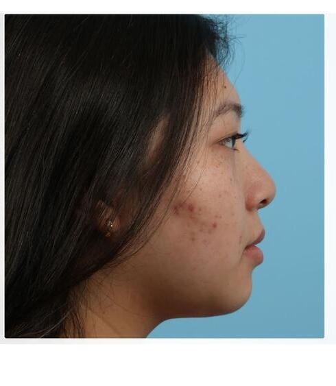 Submental Liposuction Before & After Image