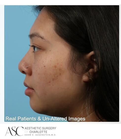 Submental Liposuction Before & After Image