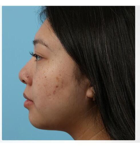 Submental Liposuction Before & After Image