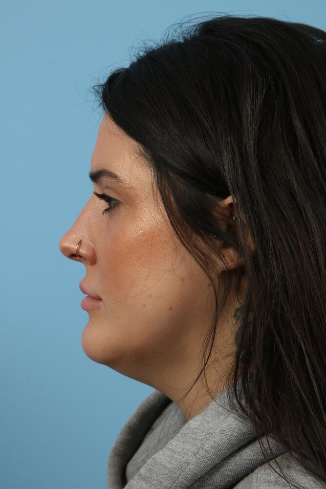 Submental Liposuction Before & After Image