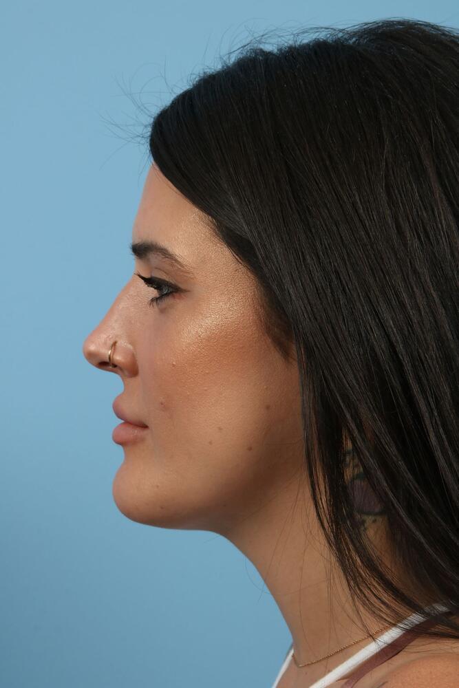 Submental Liposuction Before & After Image