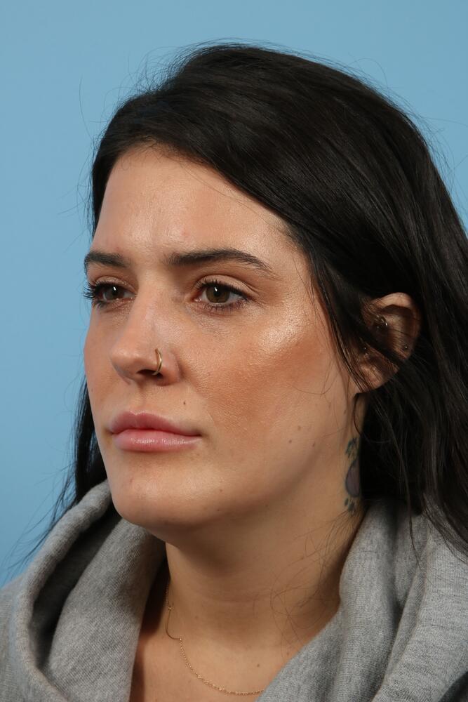 Submental Liposuction Before & After Image