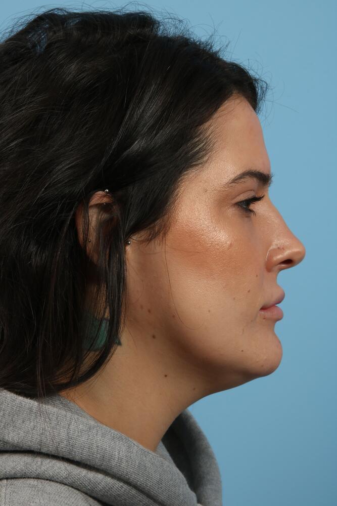 Submental Liposuction Before & After Image