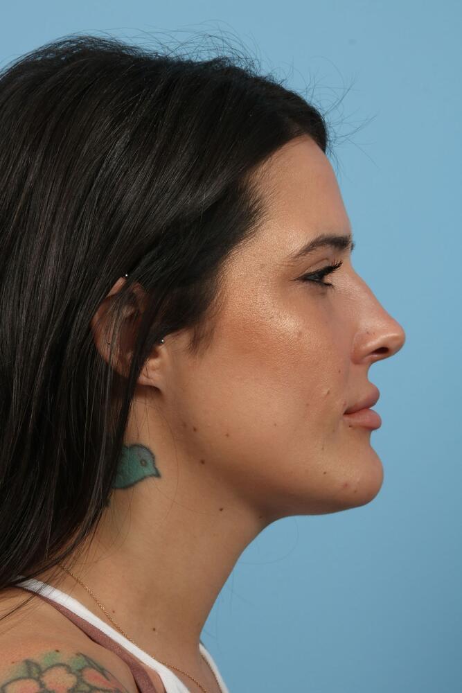 Submental Liposuction Before & After Image