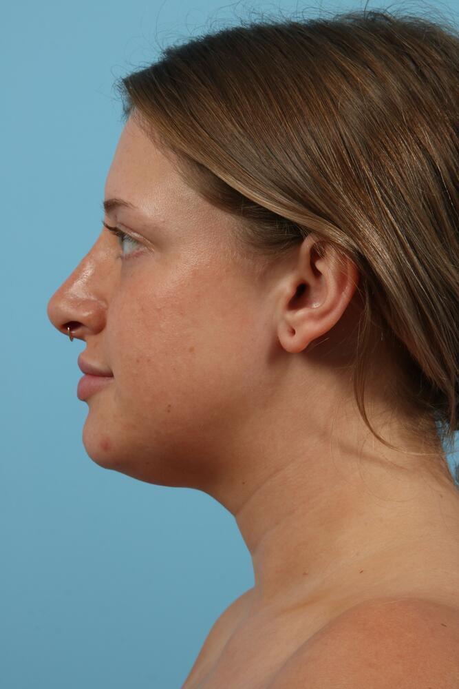 Submental Liposuction Before & After Image