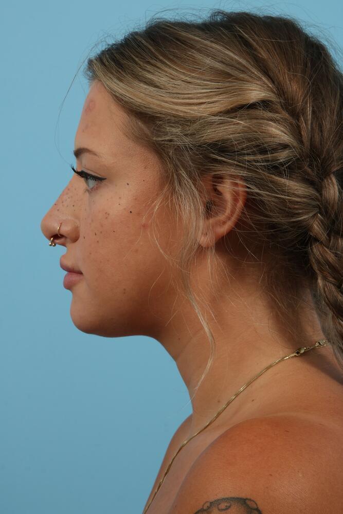 Submental Liposuction Before & After Image