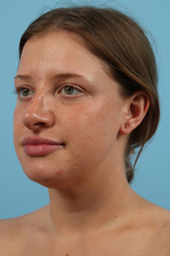 Submental Liposuction Before & After Image