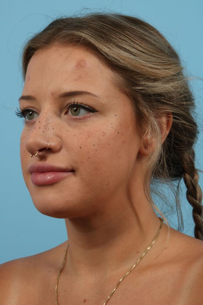 Submental Liposuction Before & After Image