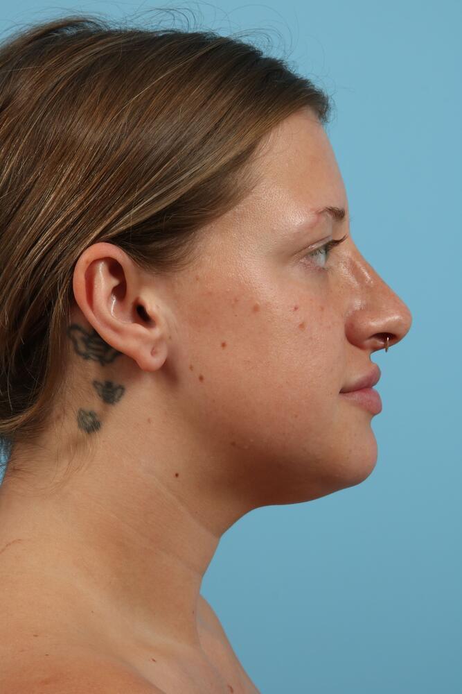 Submental Liposuction Before & After Image