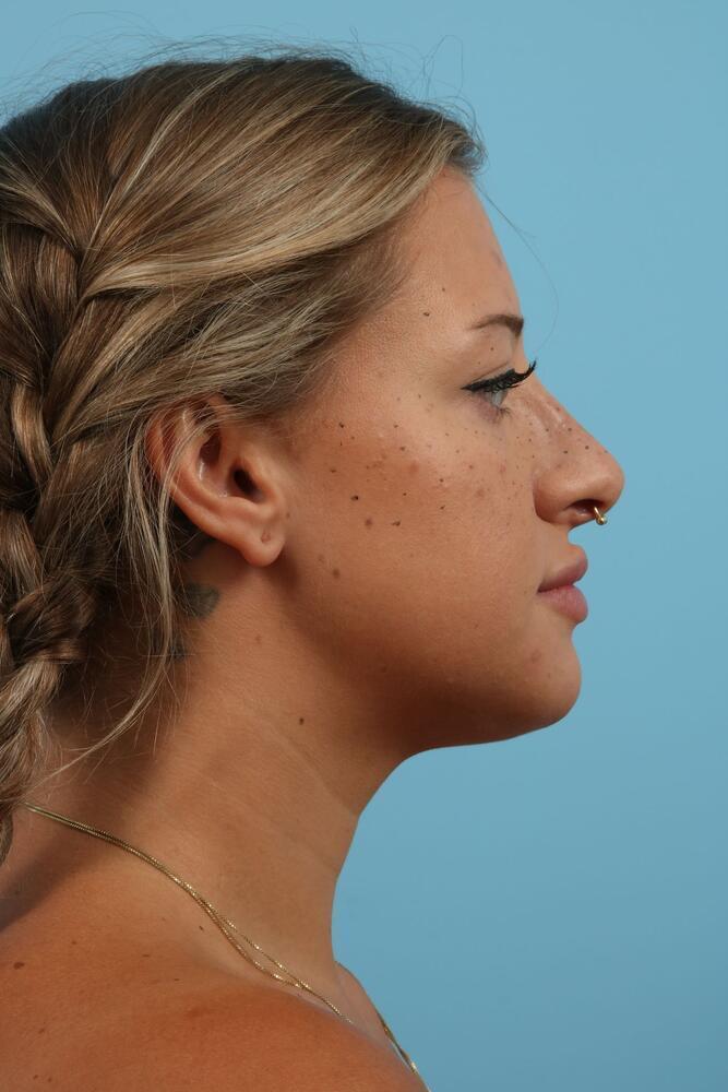 Submental Liposuction Before & After Image