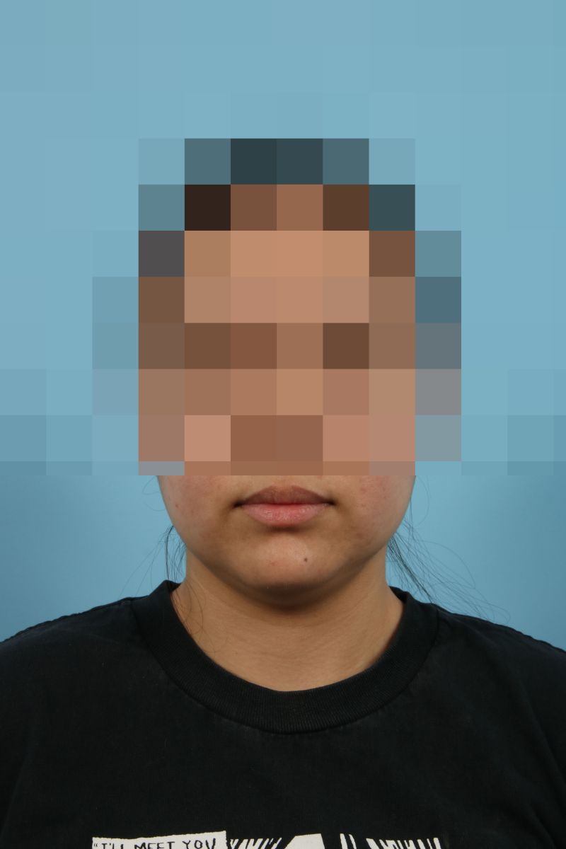 Submental Liposuction Before & After Image