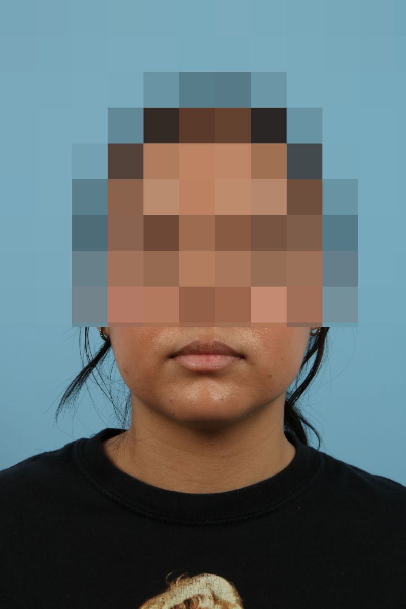 Submental Liposuction Before & After Image