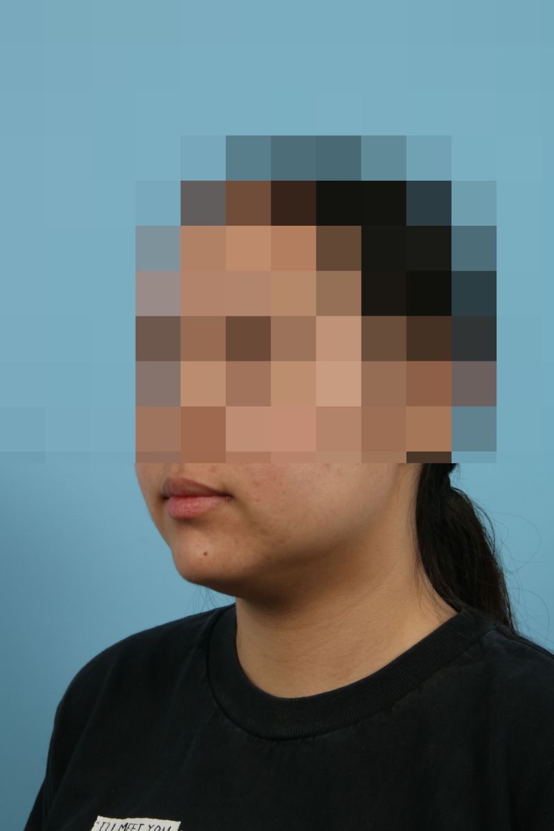 Submental Liposuction Before & After Image