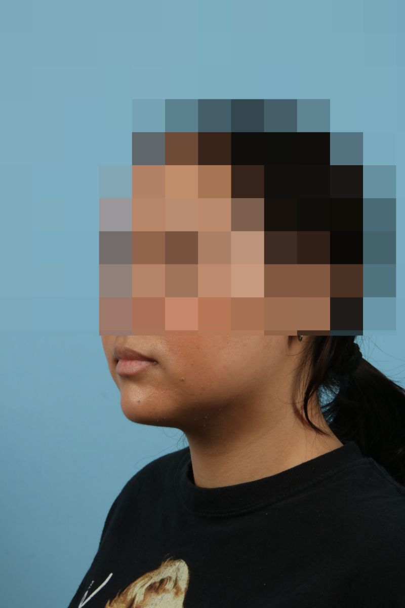 Submental Liposuction Before & After Image