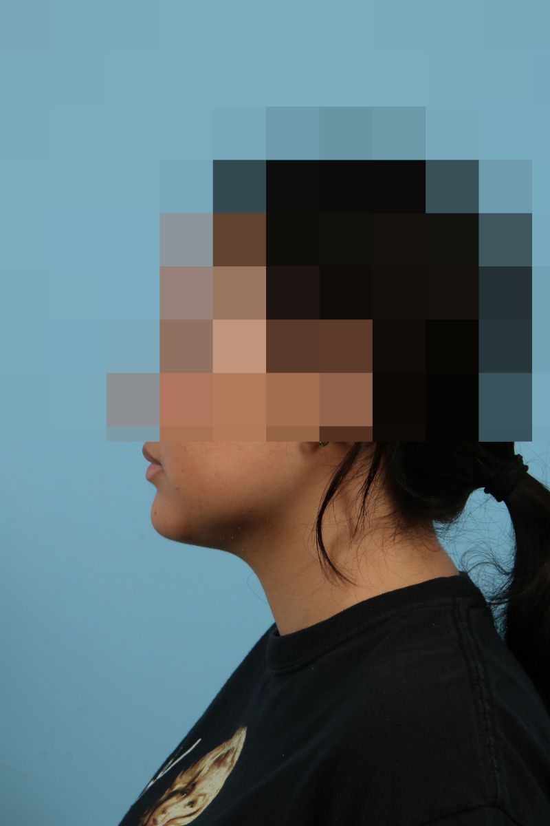 Submental Liposuction Before & After Image