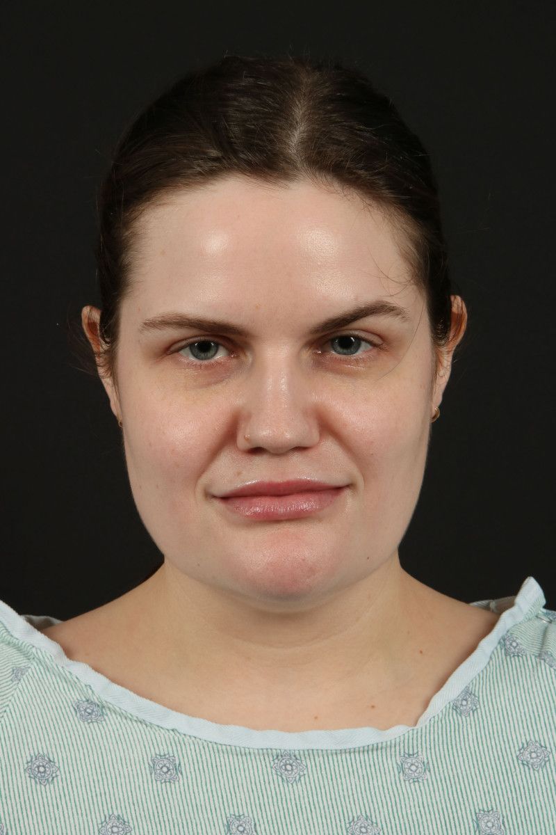 Submental Liposuction Before & After Image