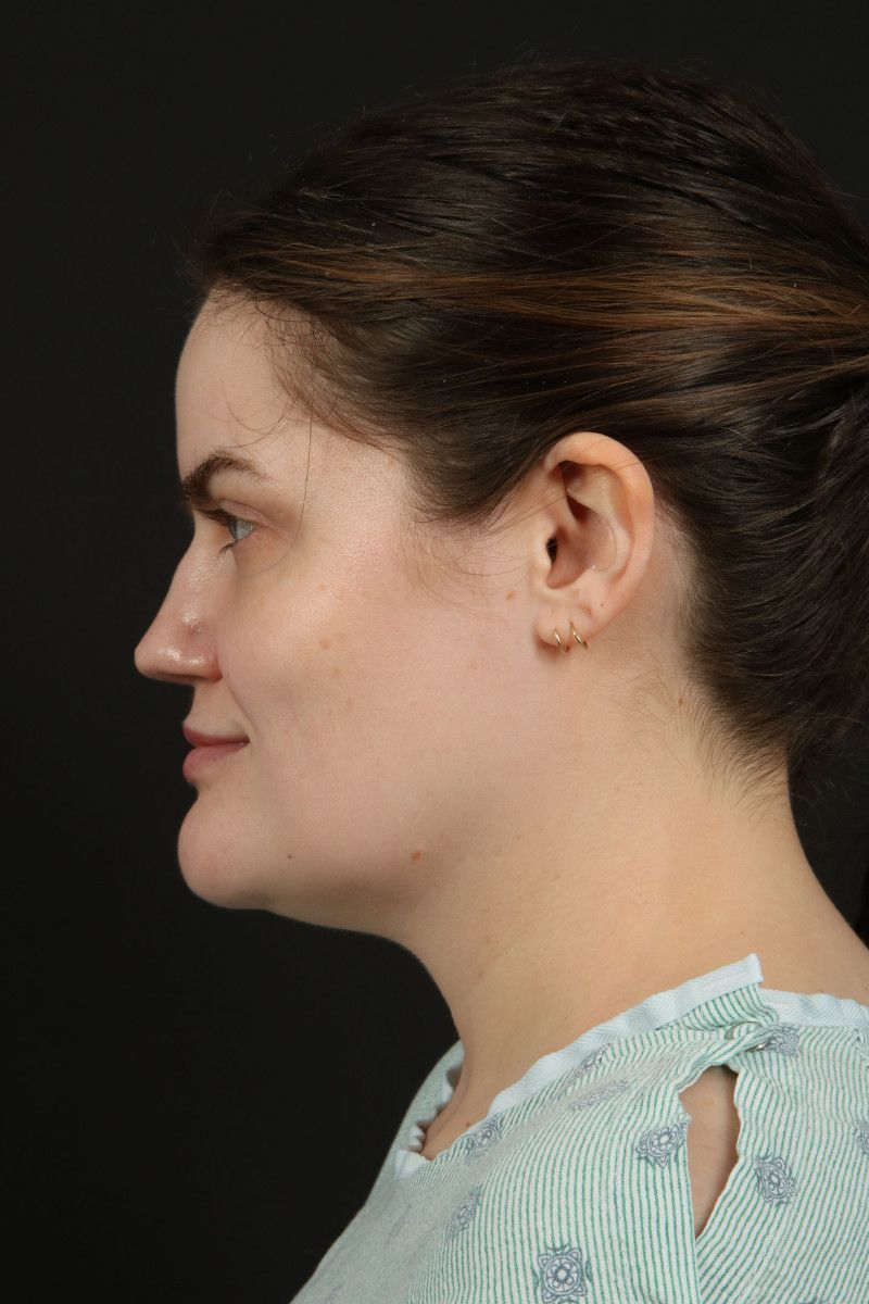 Submental Liposuction Before & After Image