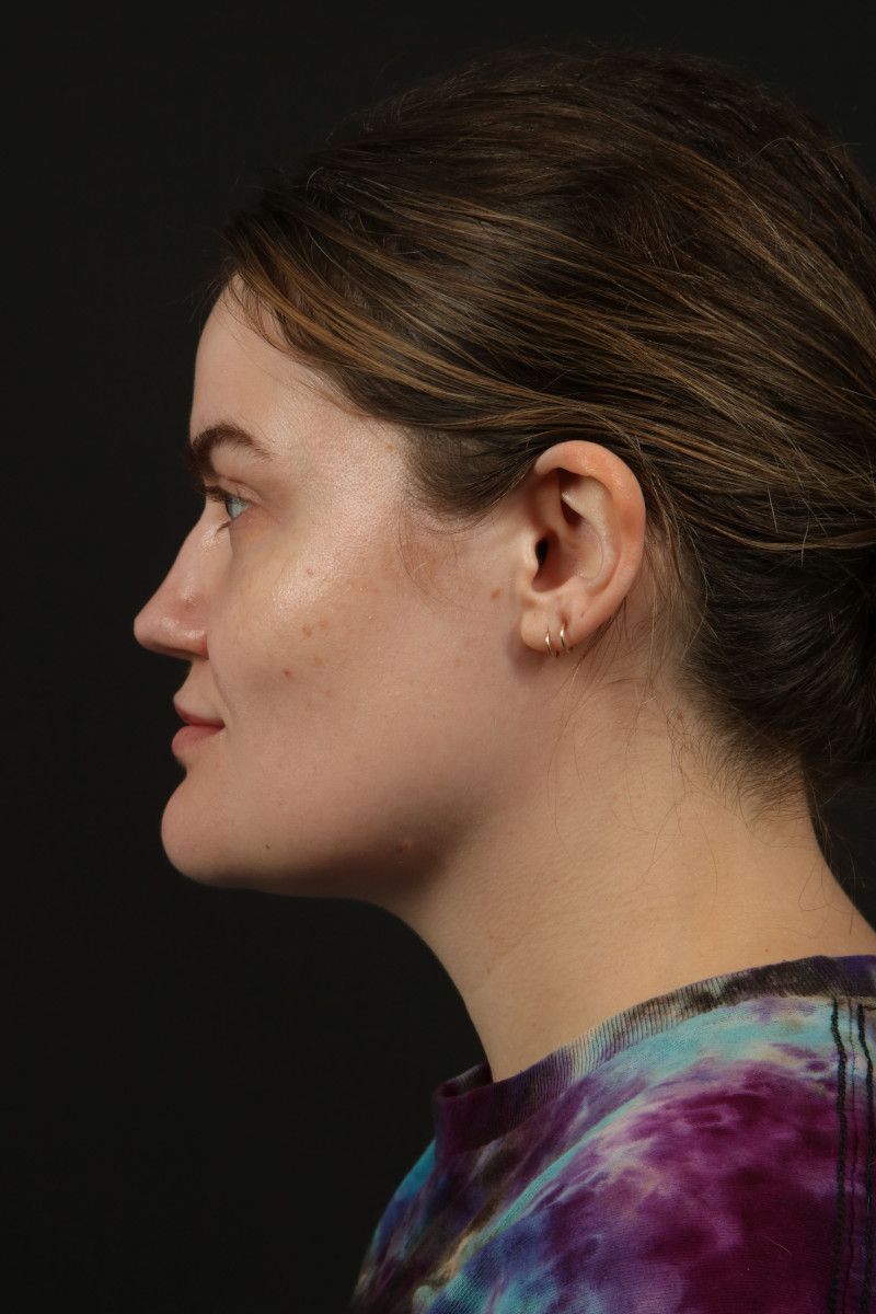 Submental Liposuction Before & After Image