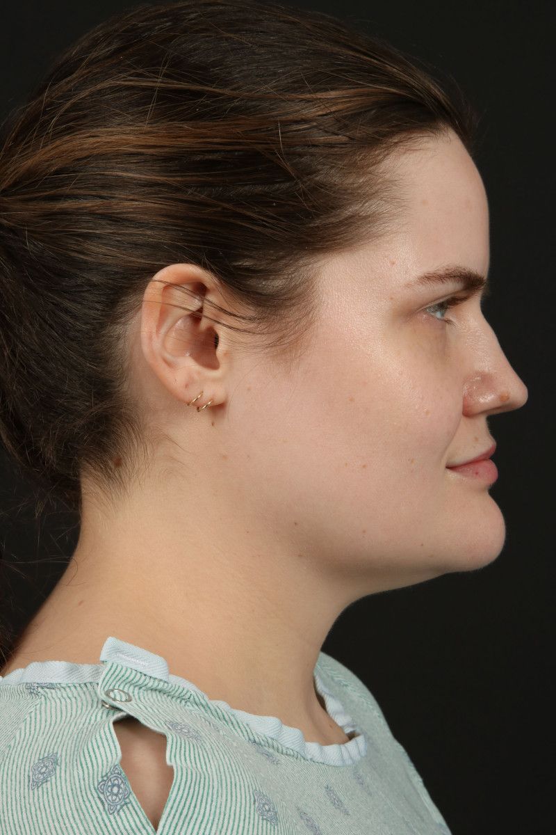 Submental Liposuction Before & After Image