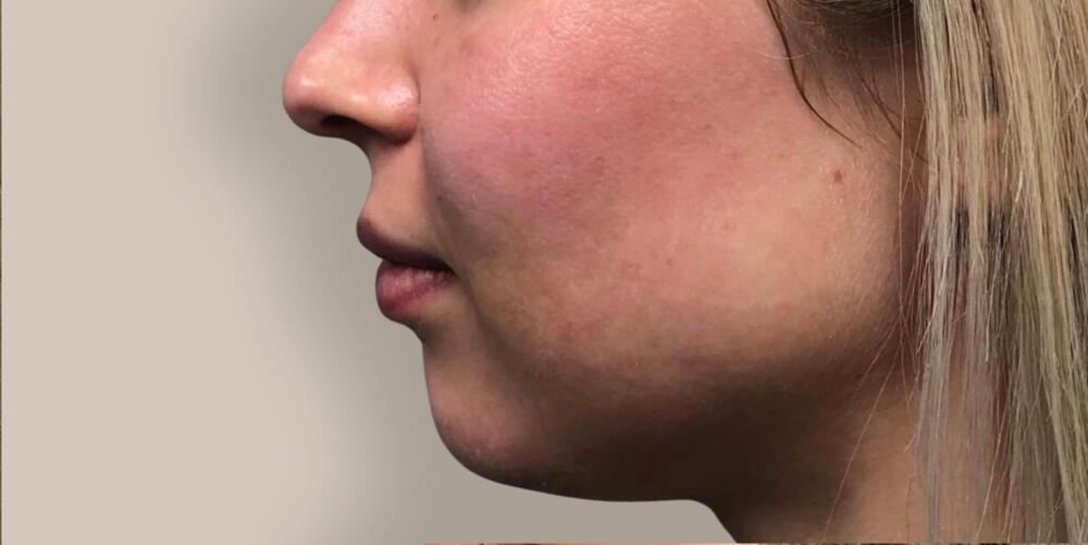 Chin Filler Before & After Image