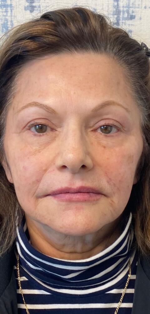 Facial Balancing Before & After Image