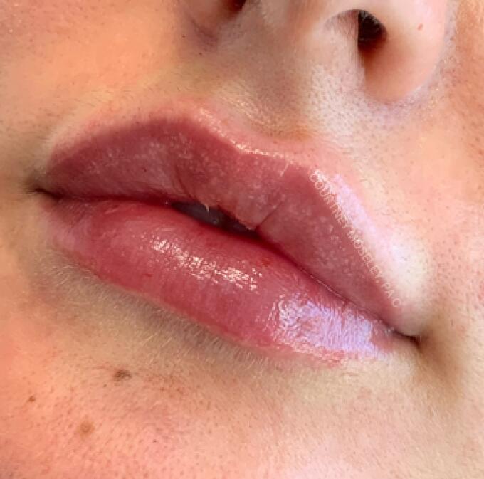 Lip Filler Before & After Image