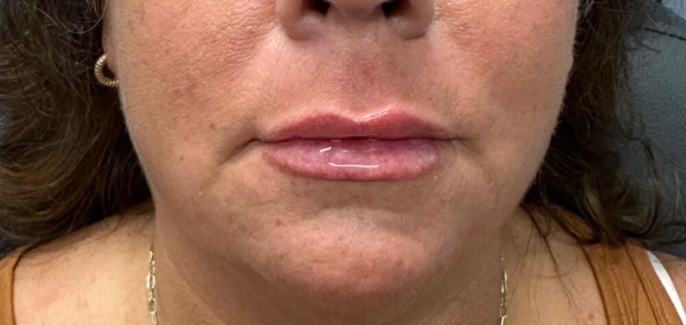 Lip Filler Before & After Image