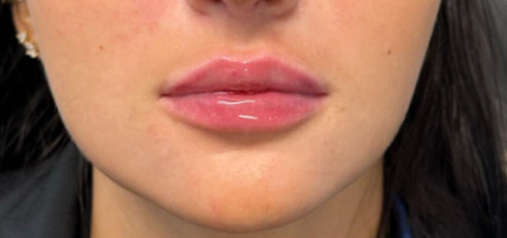 Lip Filler Before & After Image