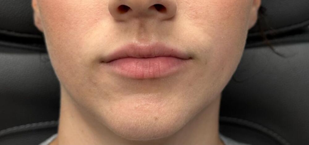 Lip Filler Before & After Image