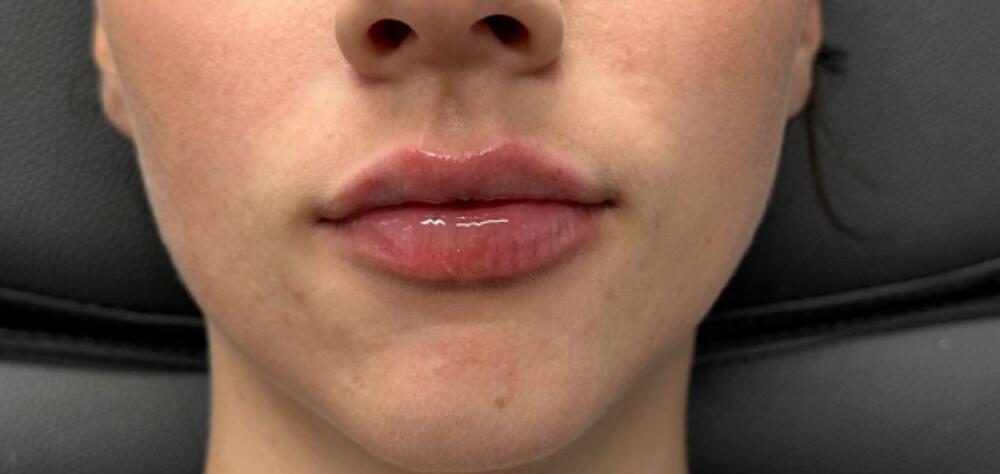 Lip Filler Before & After Image