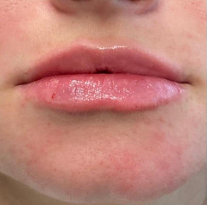 Lip Filler Before & After Image