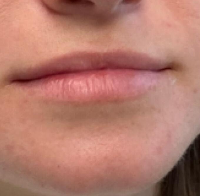 Lip Filler Before & After Image