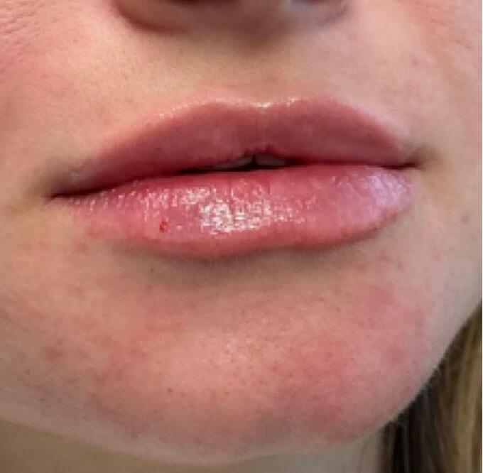 Lip Filler Before & After Image