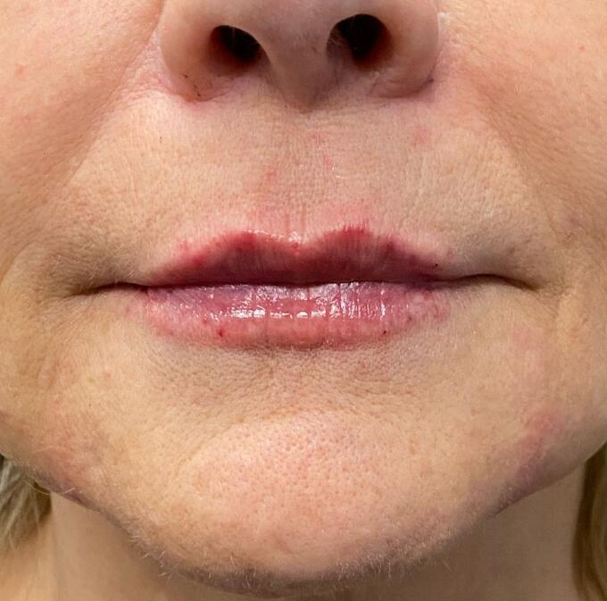 Lip Filler Before & After Image