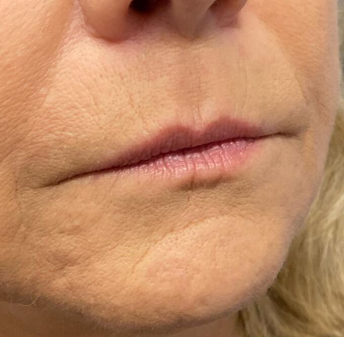 Lip Filler Before & After Image