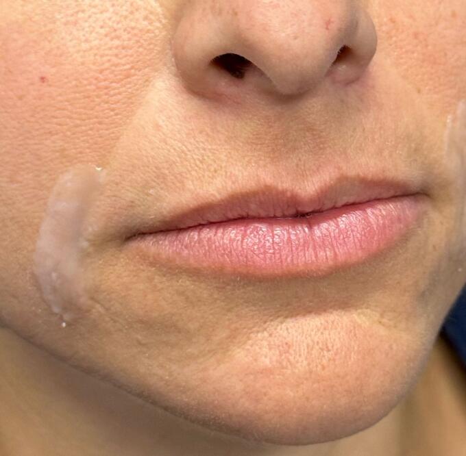 Lip Filler Before & After Image