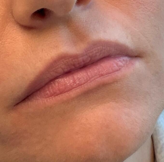 Lip Filler Before & After Image