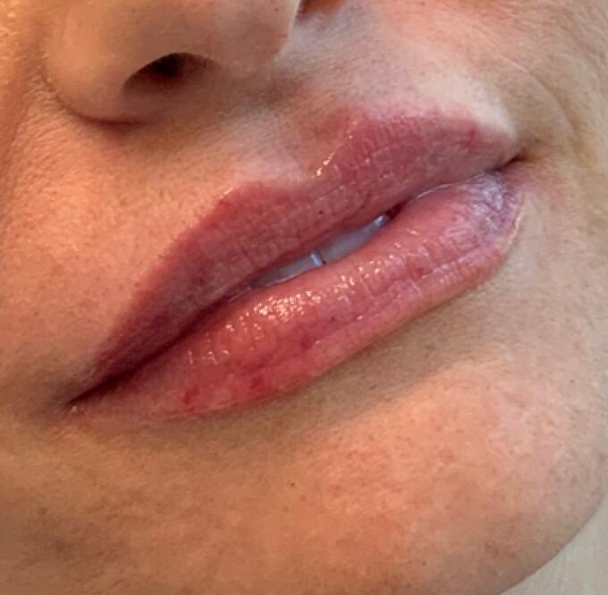 Lip Filler Before & After Image