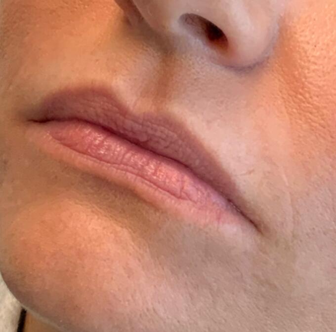 Lip Filler Before & After Image