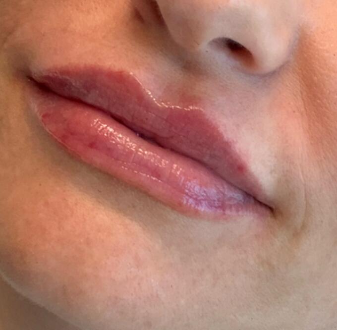 Lip Filler Before & After Image