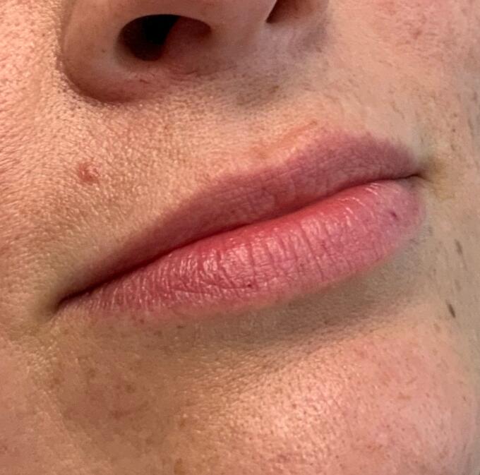 Lip Filler Before & After Image