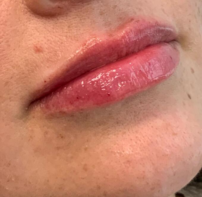 Lip Filler Before & After Image