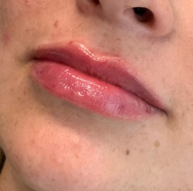 Lip Filler Before & After Image