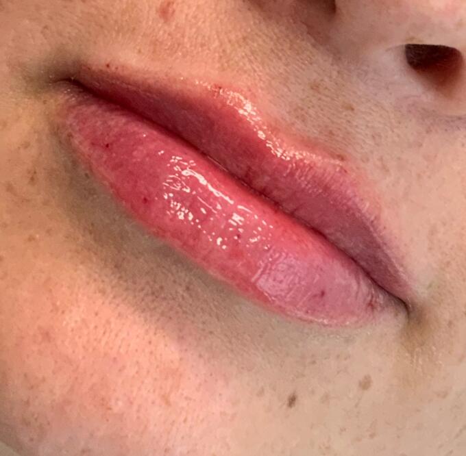 Lip Filler Before & After Image