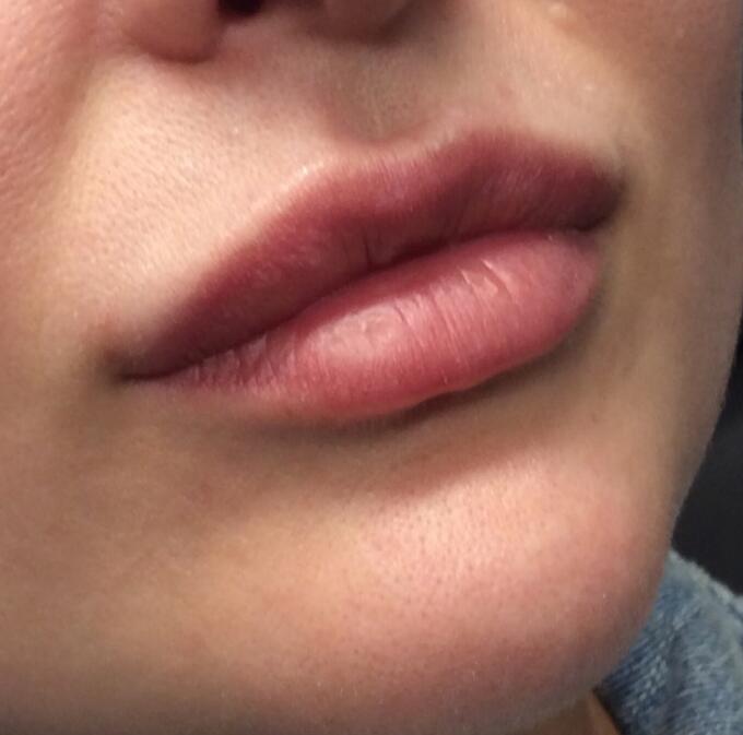 Lip Filler Before & After Image