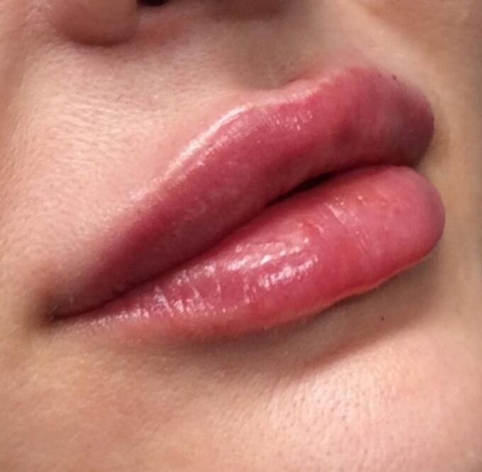 Lip Filler Before & After Image